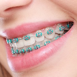 Close-up of woman’s smile with braces