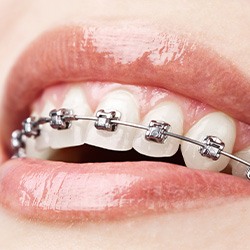 Close-up of person’s smile with metal braces