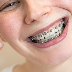 Smiling woman pointing at her braces