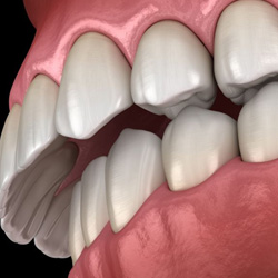 Digital illustration of an overbite against dark background