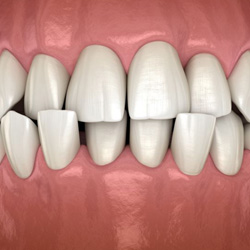 Illustration of a crossbite viewed from the front