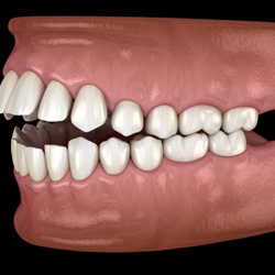 Illustration of an open bite viewed from the side