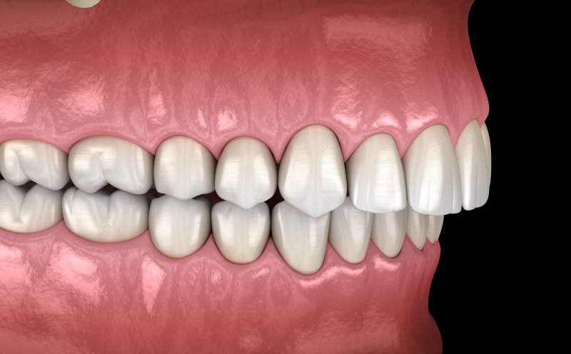 a digital image of an overbite