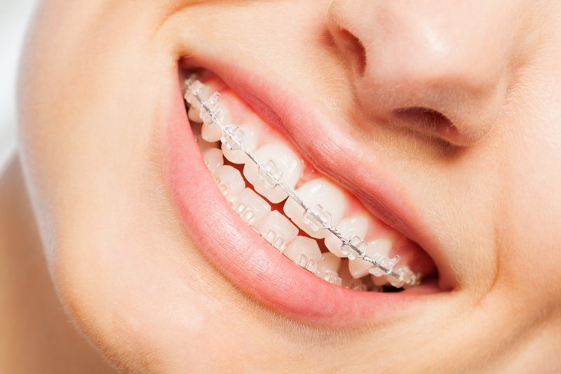 up-close view of ceramic braces